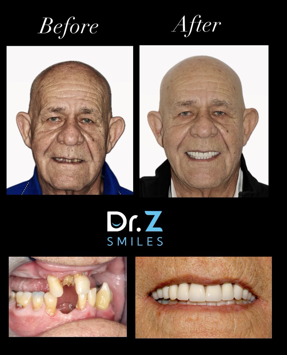 DrZSmiles's tweet photo. See the incredible transformation for yourself! This patient came to us with a wish to regain his smile and functionality – and that’s exactly what he got at Dr. Z Smiles.

He’s now enjoying life with a full, radiant smile and all the functionality he missed. His gratitude says it all! 

Ready to embark on your own journey to a perfect smile? Connect with us! 📞 954-443-3030

#SmileTransformation #DentalImplantsWork #BeforeAndAfter #LifeChangingDentistry #PembrokePinesSmiles #HealthySmileHealthyLife #FullMouthRehabilitation #DrZSuccess #ConfidentSmile #ImplantDentistry #CosmeticDentistry #NewSmileNewLife #DentalArtistry #drzsmiles