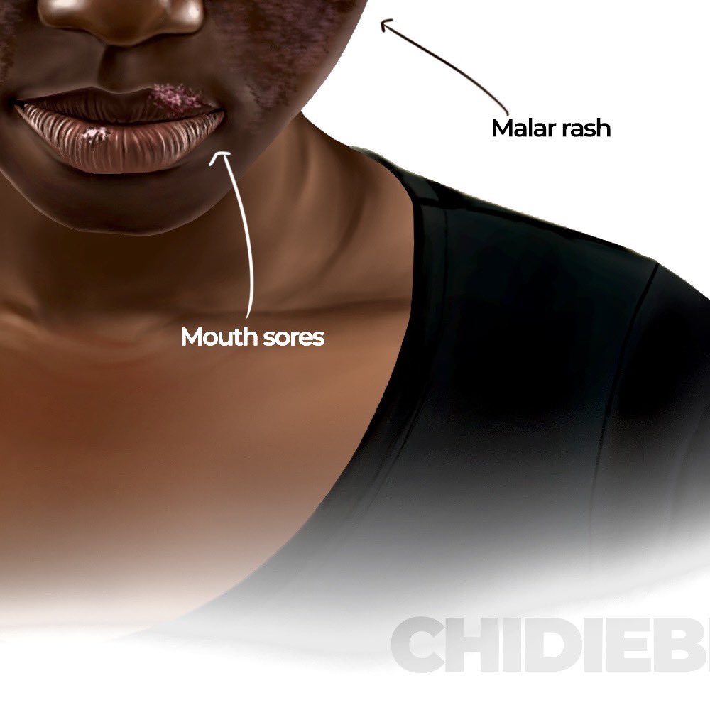According to a survey in 2010, Black People confused Lupus with HIV, cancer, or witchcraft due to lack of proper education about the disease.

Lupus, a complex autoimmune disease, affects individuals of all races and ethnicities, but research indicates that it disproportionately
