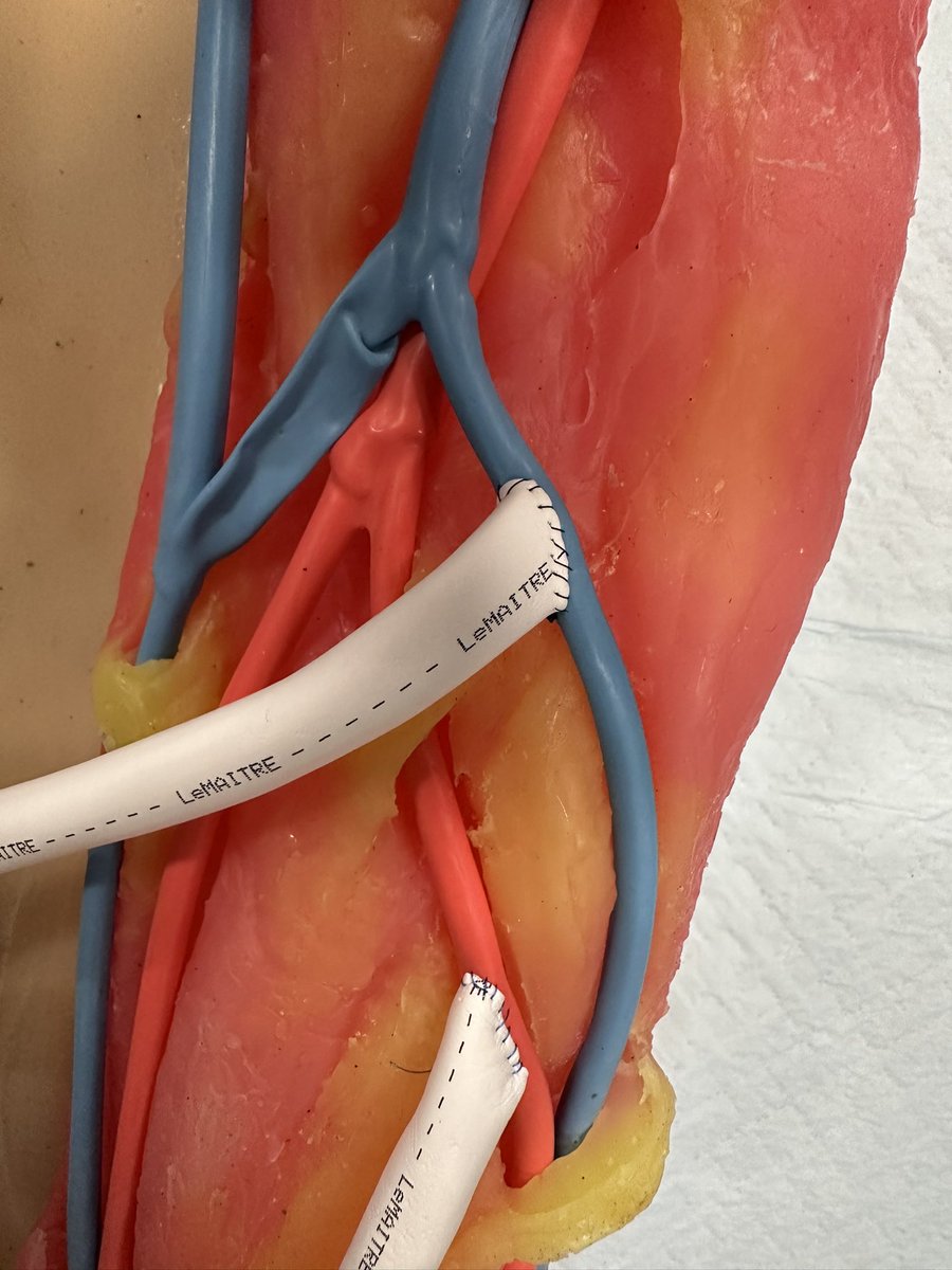 Check out the suture line on the first anastomosis by med student Arthur de la Cruz-Lynch!