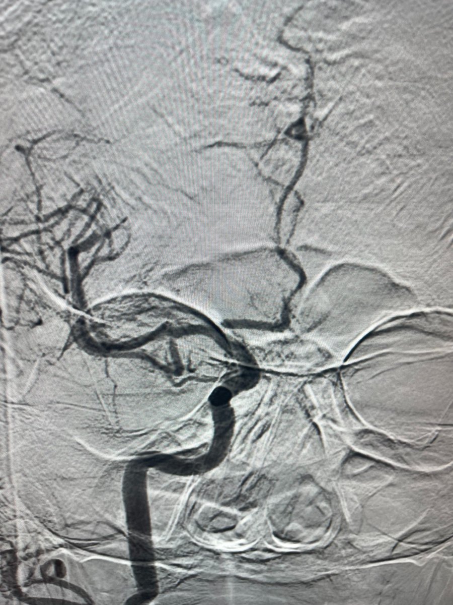 terumoneuro's tweet photo. Dr. Eric Sauvageau and the team at Baptist Health successfully utilized the ERIC Retrieval Device for an MCA, M1 occlusion on the first pass, achieving TICI 2b recanalization.
#ERICRetrievalDevice #retrievaldevice #NoWaitTime #MicroVention #StrokeSolution #neurovascular #neurotwitter