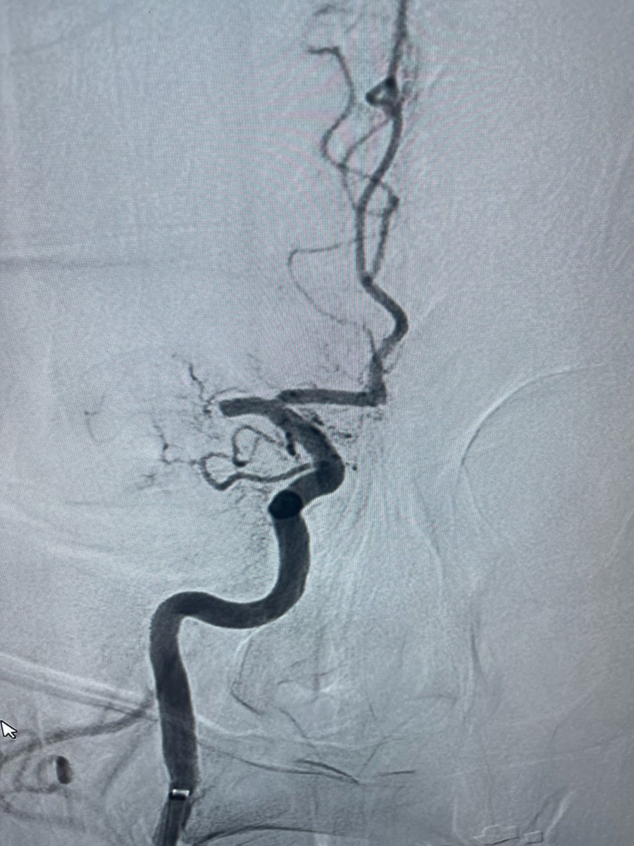 terumoneuro's tweet photo. Dr. Eric Sauvageau and the team at Baptist Health successfully utilized the ERIC Retrieval Device for an MCA, M1 occlusion on the first pass, achieving TICI 2b recanalization.
#ERICRetrievalDevice #retrievaldevice #NoWaitTime #MicroVention #StrokeSolution #neurovascular #neurotwitter