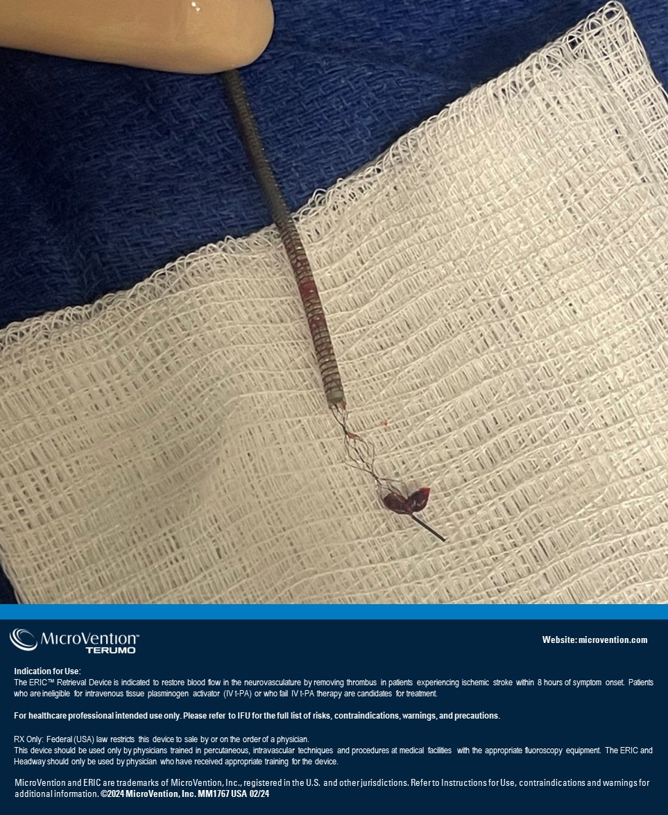 terumoneuro's tweet photo. Dr. Eric Sauvageau and the team at Baptist Health successfully utilized the ERIC Retrieval Device for an MCA, M1 occlusion on the first pass, achieving TICI 2b recanalization.
#ERICRetrievalDevice #retrievaldevice #NoWaitTime #MicroVention #StrokeSolution #neurovascular #neurotwitter