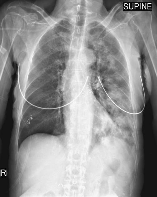 Can high PEEP worse oxygenation? Yes! A recent case to illustrate #foamed #foamCC A person has a witnessed aspiration event after a procedure and is severely hypoxemic requiring intubation radiopaedia.org/articles/12302 (image)