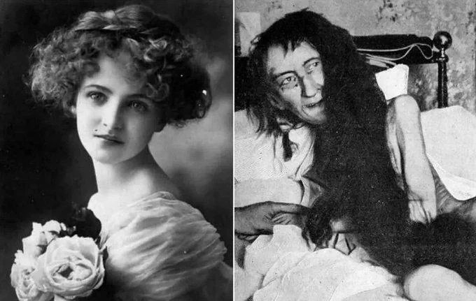The lost girl, 1874 Blanche Monnier was a Parisian socialite, known for her beauty. She wished to marry an old lawyer that her mother disapproved of, so she locked her in a small dark room in her attic for 25 years. the left one's taken in the 1870's, the right in 1901.