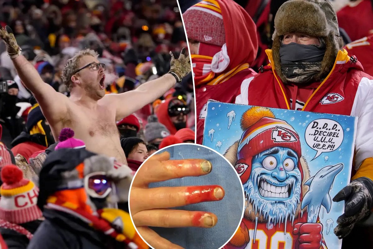 TRAGIC: Many fans who suffered frostbite at the #Dolphins, #Chiefs playoff game need AMPUTATIONS.

70% of the frostbite patients affected by the recent extreme cold in the Kansas City area are being recommended for amputations, per Fox.
