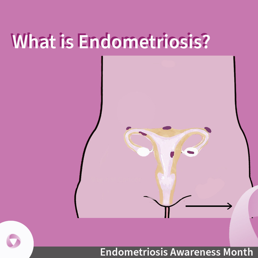 LondonGynae's tweet photo. March is #EndometriosisAwarenessMonth and in the UK, 1 in 10 women of reproductive age suffer from the condition - but sadly, figures show it takes an average of 7.5 years to receive a diagnosis. 1/2 https://t.co/H7c9dNl2Ao