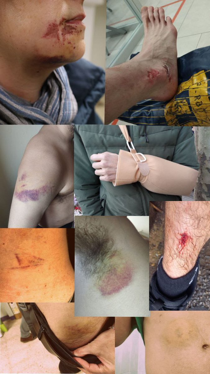 🚔‼️ Martxoaren 3ko manifestazioan Ertzaintzaren kargaren ondorioz zauritutako hainbat pertsonaren argazkiak bildu ditu <a href="/LABGasteiz/">LAB Gasteiz Lautada Errioxa</a> sindikatuak, "inpunitatearekin amaitzeko neurriak" exijituz.

🗣️ "Polizia demokratikoaren jokabidearen ondorio batzuk" ▶️ alea.eus/gasteiz/170975…