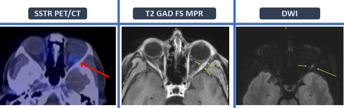 Orbital metastases from well diff NETs are well known and the primary NET is usually in the small bowel. This patient presented w/ mild diplopia on left horizonal gaze (had known SB NET). Small metastasis in the left lateral rectus muscle. Radiotherapy is very effective and safe.