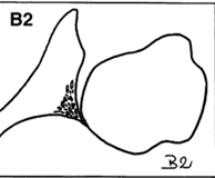 Walch B2 glenoid dysplasia and glenohumerar OA Graphic from DOI10.1007/s00590-012-1119-4