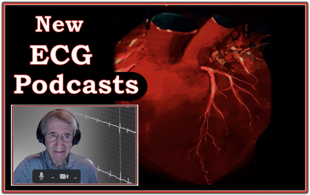 My new Podcasts are out = i) Common Errors in ECG Interpretation — ii) ECG Errors leading to missing Acute Coronary Occlusion (OMI) = Why millimeter STEMI criteria are outdated and miss >30% of acute OMIs — Easy LINK = tinyurl.com/KG-ECG-Podcasts — #ECG - #ECG_Ken_Grauer - #EKG — :)