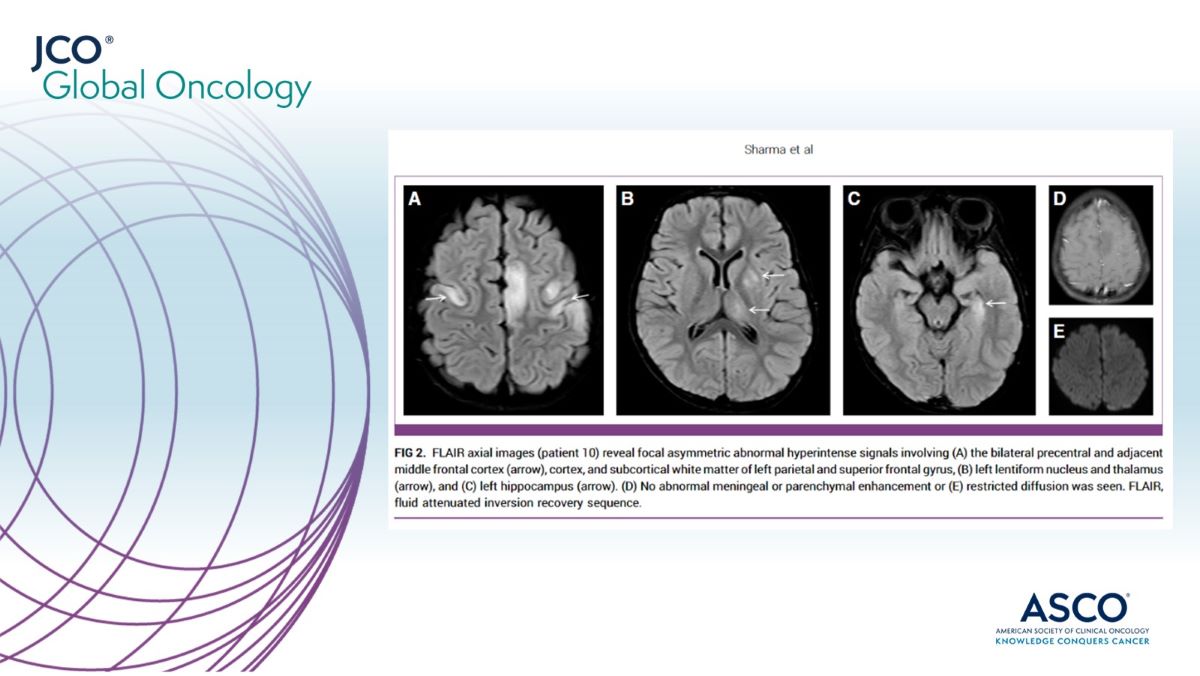 Presentation of measles in an immunocompromised child can go unnoticed. Encephalitis #MIBE presenting as epilepsia partialis continua #EPC or pneumonia might be the initial manifestation of the disease. ➡️ brnw.ch/21wHFYO @DHCA11 #PedCSM #GlobalOnc