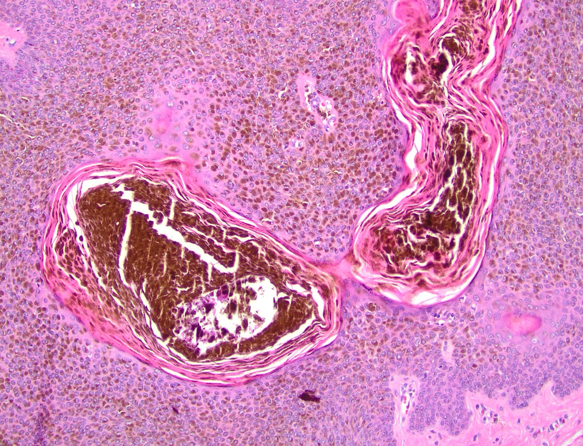 dgbrackett's tweet photo. You gotta admit that this SK did an impressive job with the pigmentation. #dermpath #beautyintheB9 https://t.co/gV2IVLzaYT