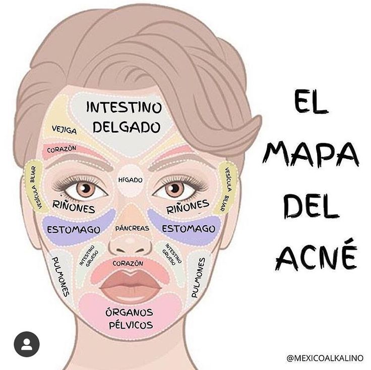RincnCuriosoo's tweet photo. El mapa del Acné ✨️👇🧠 https://t.co/hAKUaIynT5