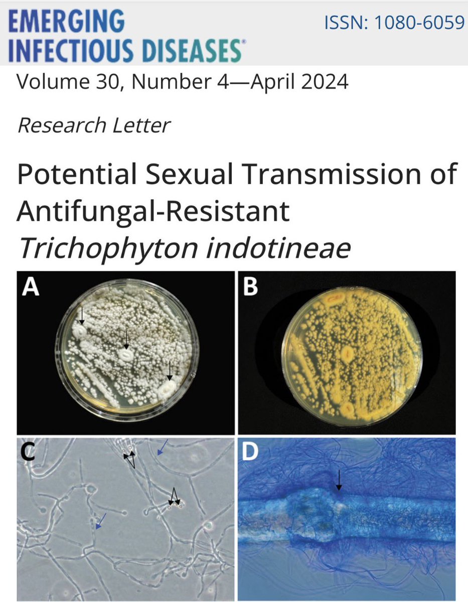 Antifungal-resistant Trichophyton indotineae identified as a cause of genital lesions, possibly transmitted sexually. Diagnosis beyond visual inspection is crucial to avoid mismanagement. #Dermatophytosis #AntifungalResistance #PublicHealth'

wwwnc.cdc.gov/eid/article/30…