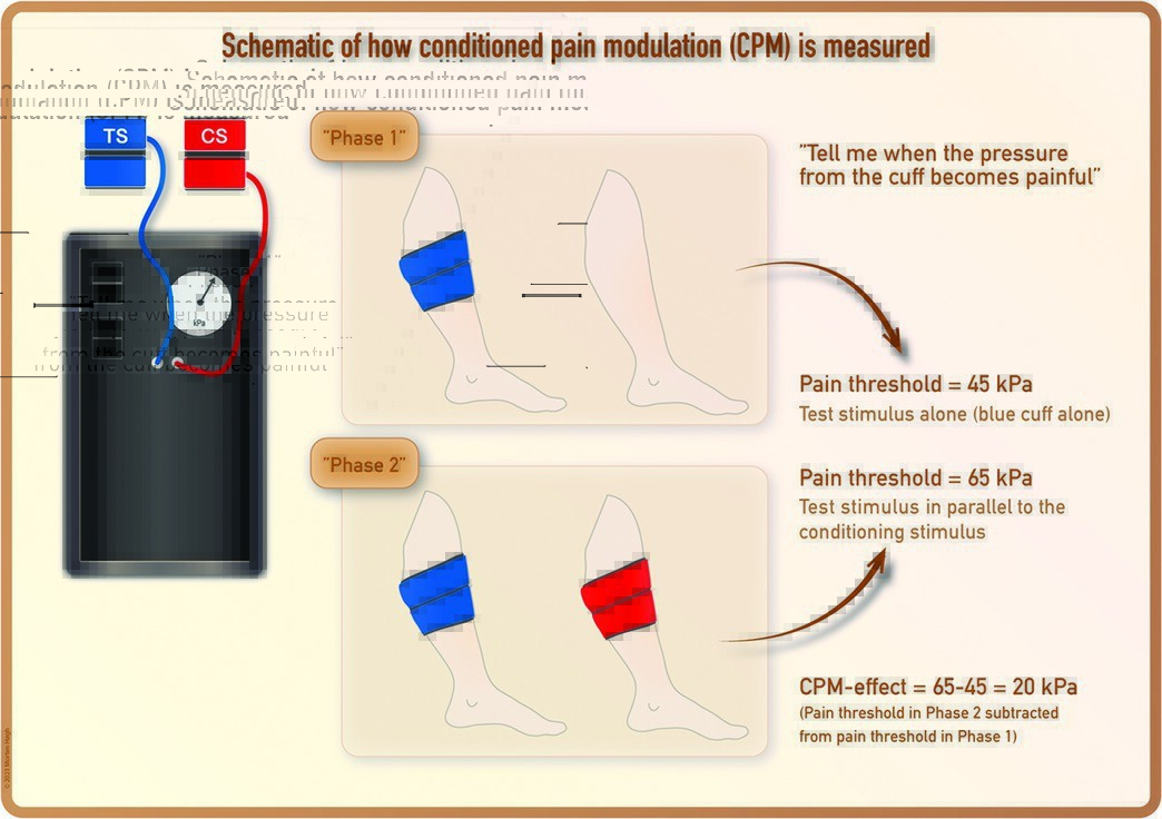 JOSPT's tweet photo. Interested in another dose of our #PainScienceInPractice series π€
Part 7 "How Is Descending Modulation of Pain Measured?" is OUT NOW
Link β‘οΈ https://t.co/Zcn5ZMtE6O
#yourJOSPT #PainScience https://t.co/5XqWSQYdzO