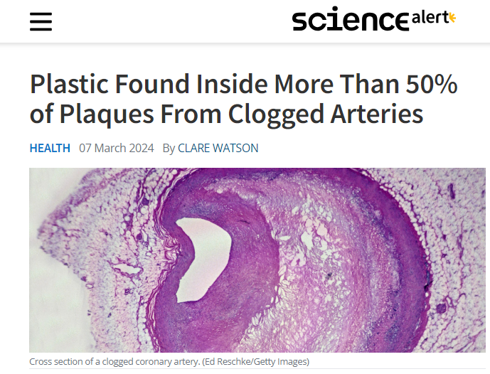 NateB_Panic's tweet photo. Researchers extracted arterial plaques from 257 patients. 50% contained microplastics. Those with microplastics in plaques were 4.5x more likely to have a stroke or die in the 3 years after plaque removal, indicating the plastics had triggered systemic inflammatory processes ☠️ https://t.co/rE9ivr2aof