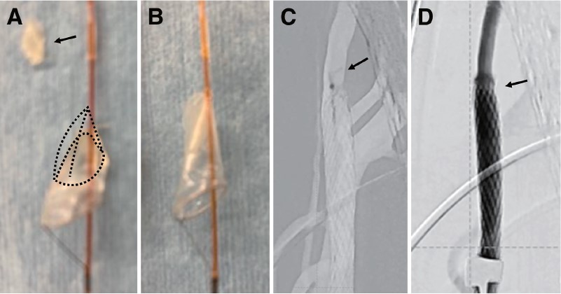 JNETjournal's tweet photo. Case Report
Successful Retrieval of Filter Embolic Protection Device Fragment Trapped by a Carotid Stent: A Case Report
https://t.co/GgYD6RNCIw
#CarotidArteryStenting #EmbolicProtectionDevice #DistalProtectionFilter #ClosedCellStent #Complication https://t.co/Ym4HHMT5DF