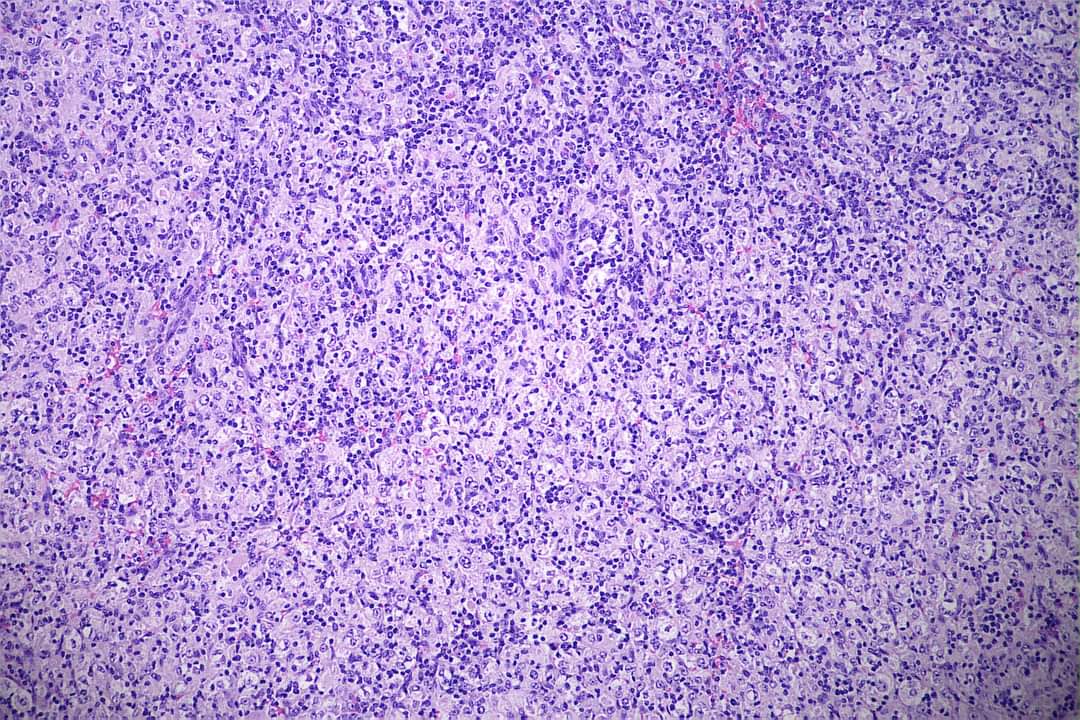 GeronimoJrLapac's tweet photo. A case in which a clinical report helps the pathologist's life. Here is a metastatic alveolar sarcoma to the thyroid.
IHC: Panck- and TFE3+
#pathplus #pathology #pathologist #entpath https://t.co/GgHgb3Octy