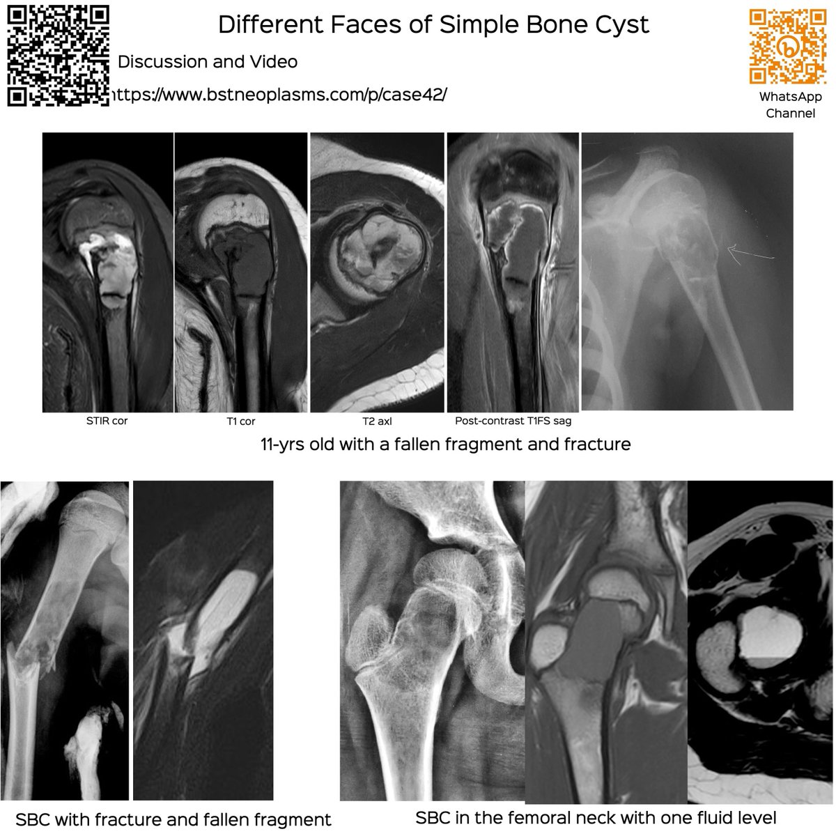 Different Faces of Simple Bone Cyst - SBC 50% occur in the humerus and 25% in the femoral neck Discussion and video bstneoplasms.com/p/case42/ #bstneoplasms #radres #humerus #simplebonecyst #SBC