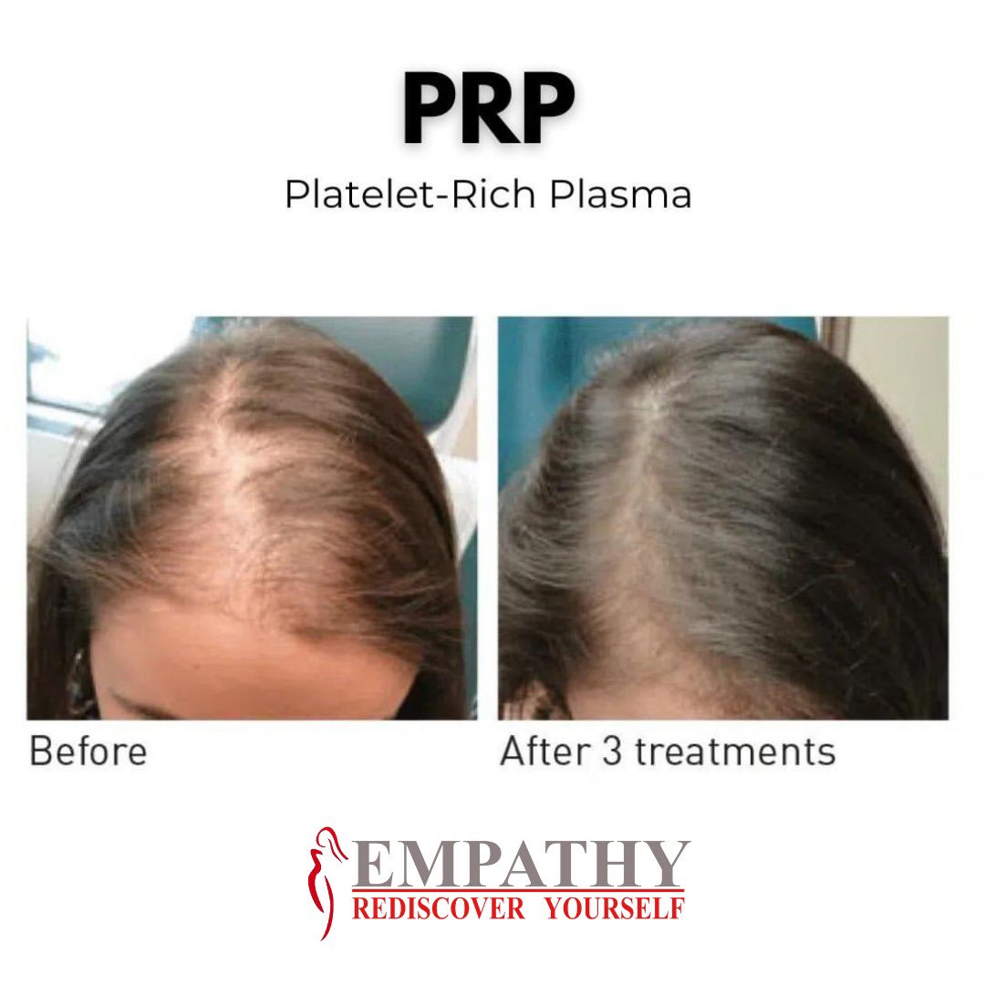 delhilaser's tweet image. PRP is used for facial skin rejuvenation and hair regrowth.PRP contains a range of growth factors and proteins that speed tissue repair &amp;amp; help hair growth.

#prpforskin #skinrejuvenation #longtermresults #beauty #glowingskin #laserclinic #smoothskin #collagenbuilding