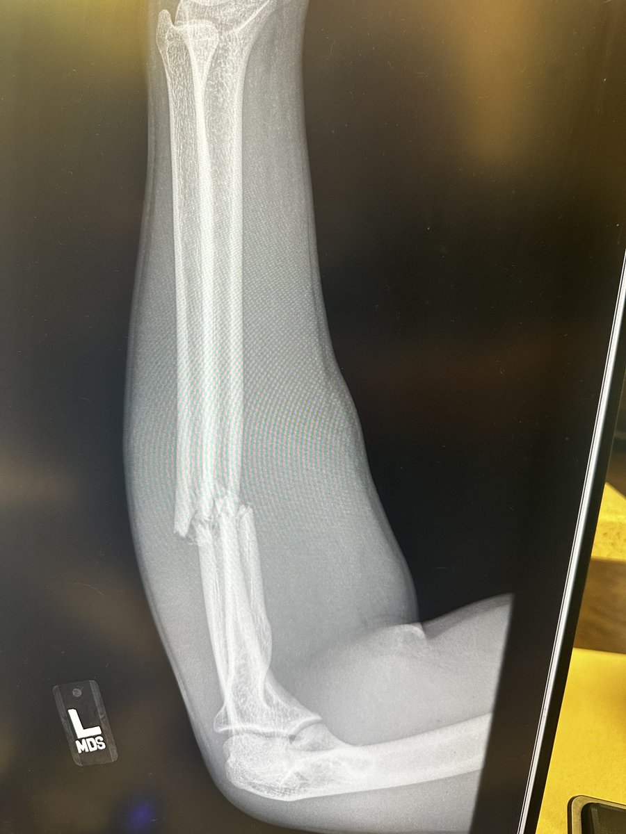 bokoebbe1's tweet photo. Yesterday, I played my last high school game. This is not how I thought my high school career would end, but Gods plan is greater than mine. I will be having surgery Tuesday and begin my route to recovery. Coming back harder than ever! 
#2becontinued https://t.co/Fa89qZzhuR