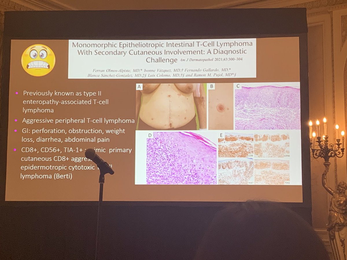 anumdilip's tweet image. Lymphoma mimics #isdp
