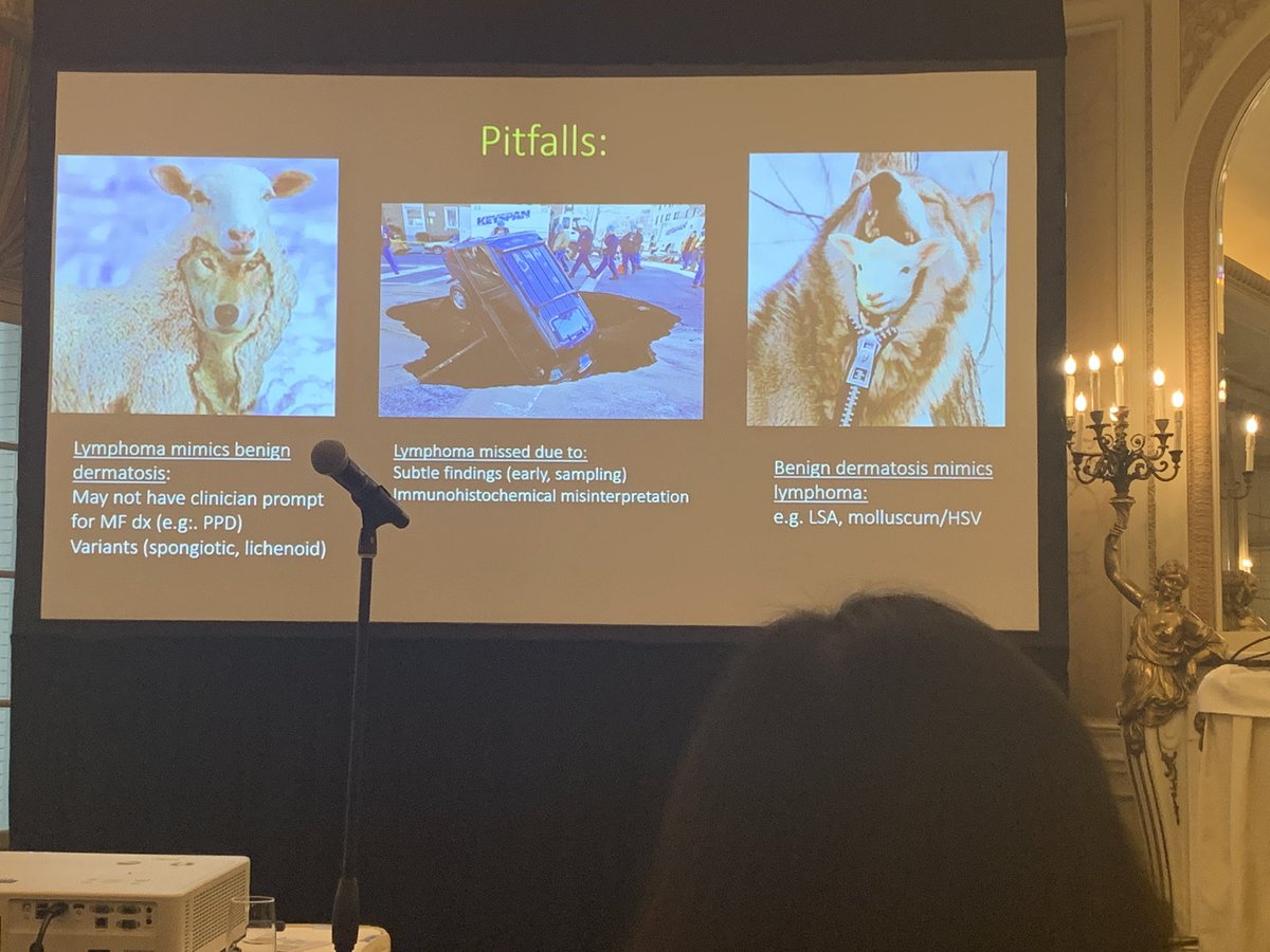 anumdilip's tweet image. Lymphoma mimics #isdp