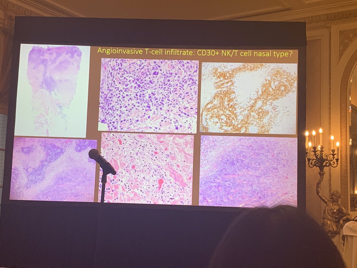 anumdilip's tweet image. Lymphoma mimics #isdp