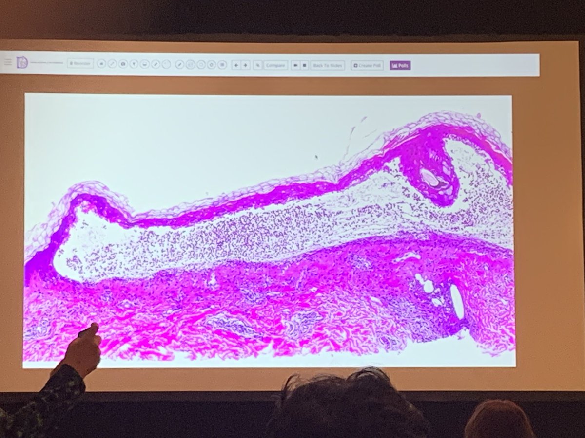 anumdilip's tweet image. Rowell syndrome rare presentation of SLE #isdp day 2