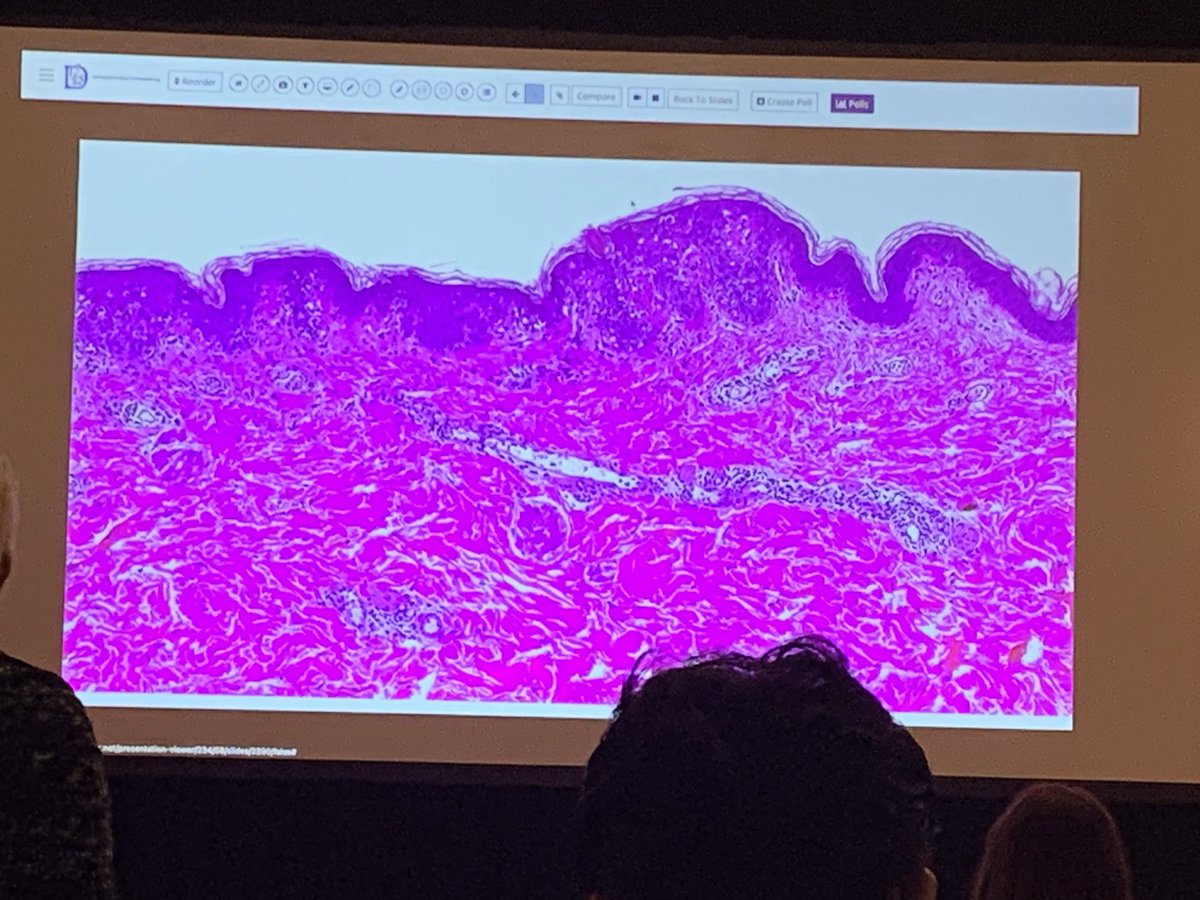 anumdilip's tweet image. Rowell syndrome rare presentation of SLE #isdp day 2