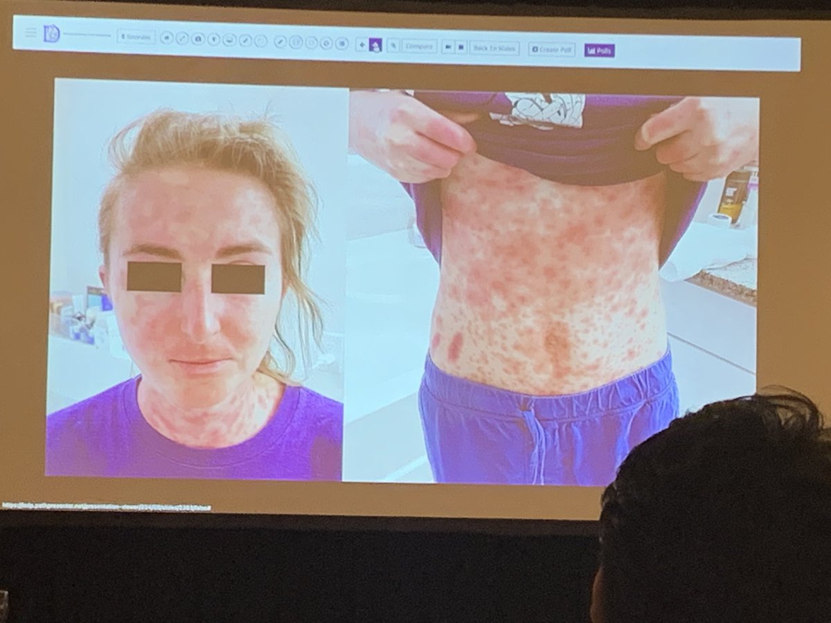 anumdilip's tweet image. Rowell syndrome rare presentation of SLE #isdp day 2