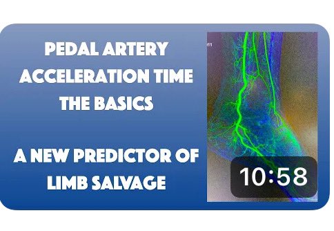 Live at Dr Tummala’s Vascular Channel-> The Basics of Pedal Acceleration Time: A New Predictor of Limb Salvage youtu.be/xaYoO6A-LFo?si… via @YouTube by the expert @JillSommerset @SIRspecialists @ACCinTouch @SIRRFS @SIR_ECS @VIVAPhysicians @CLI_Global @TraineesBSIR @CAIRweb