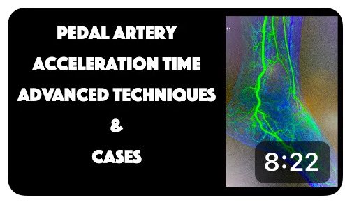 Live at Dr Tummala’s Vascular Channel -> Pedal Artery Acceleration Time Advanced Techniques: CASES youtu.be/VAXbY86XvuY?si… via @YouTube by expert @JillSommerset @SIRspecialists @ACCinTouch @SIRRFS @SIR_ECS @VIVAPhysicians @CLI_Global @TraineesBSIR @Vascular_India @ISVIRIndia