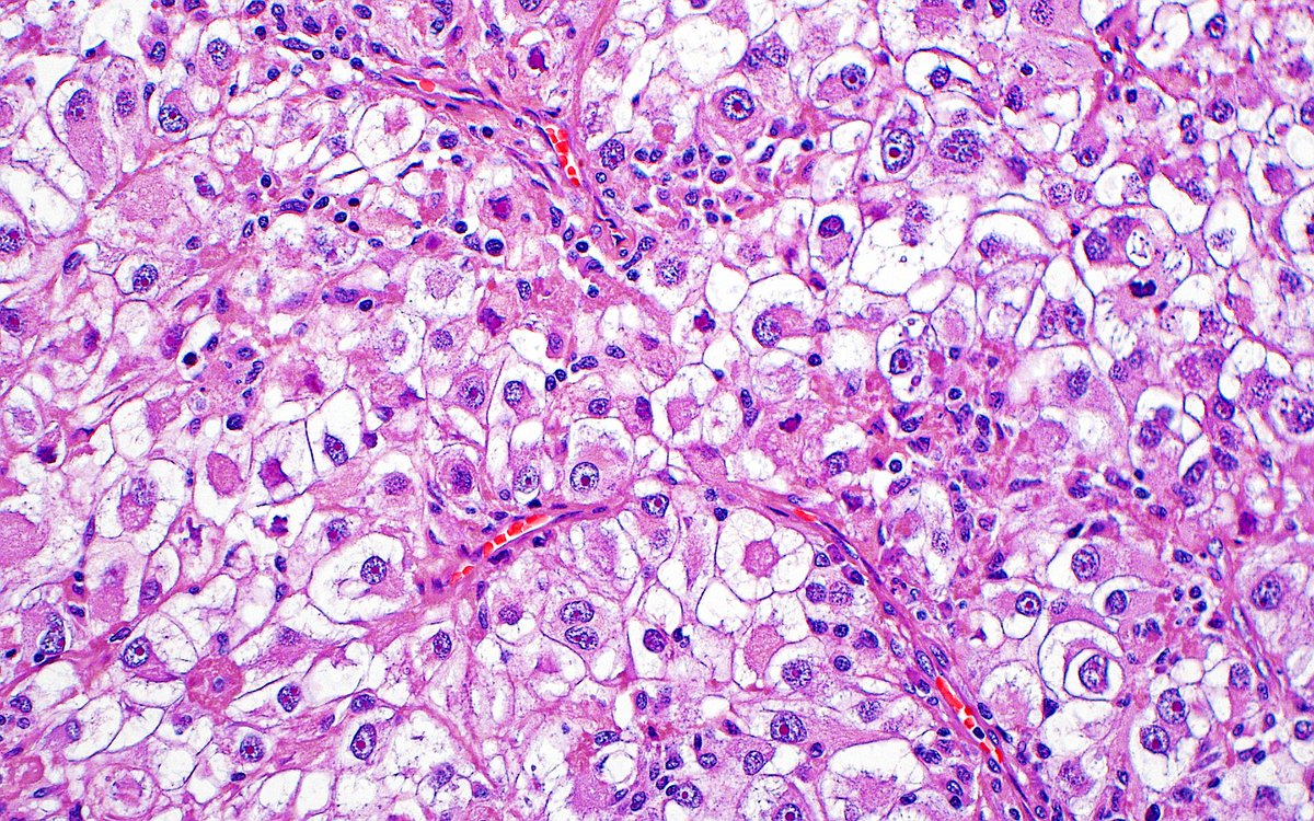 Rhabdoid cells in a renal cell carcinoma ~ #GUpath #pathology