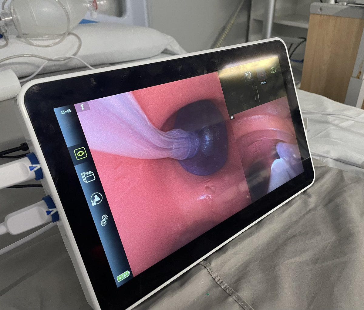 BroncoscopiaUCI's tweet photo. Hemos tenido la oportunidad de usar en el BadaFibro 2024 @hgermanstrias, el tubo endotraqueal VivaSight 2 SLT, tiene una cámara de vídeo integrada.
-Permite la visualización continua de la posición del tubo y del bloqueador endobronquial. @AmbuEurope @SOCMIC https://t.co/dgdQZN0v7y