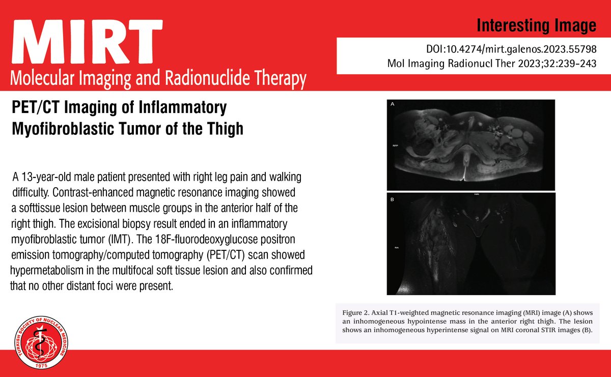 MIRTOfficial's tweet photo. PET/CT Imaging of Inflammatory Myofibroblastic Tumor of the Thigh

You can see the free full text of the research by Refia Yükseltürk et al.

Link : https://t.co/7uujbjimj9

#Inflammatory #myofibroblastic #tumor #bonescan #magnetic #resonance #imaging https://t.co/GhYflrAVSW
