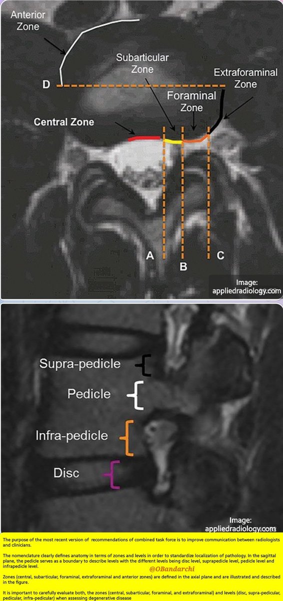 OBandarchi's tweet photo. It is important to carefully evaluate both, the ZONES (central, subarticular, foraminal extraforaminal) and LEVELS (disc, supra-pedicular, pedicular, infra-pedicular) when assessing degenerative disease. https://t.co/1YXGZwcuAn