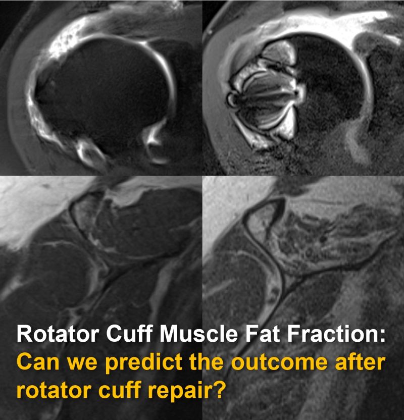 Out now in print! 👉#OpenAccess paper journals.lww.com/investigativer… (Invest Radiol) We established new thresholds for predicting the outcome of rotator cuff repair ranging from 6% to 8.3% preoperative fat fraction. @derbalgrist @balgristcampus @UZH_ch @SiemensHealth #MSKrad #Shoulder