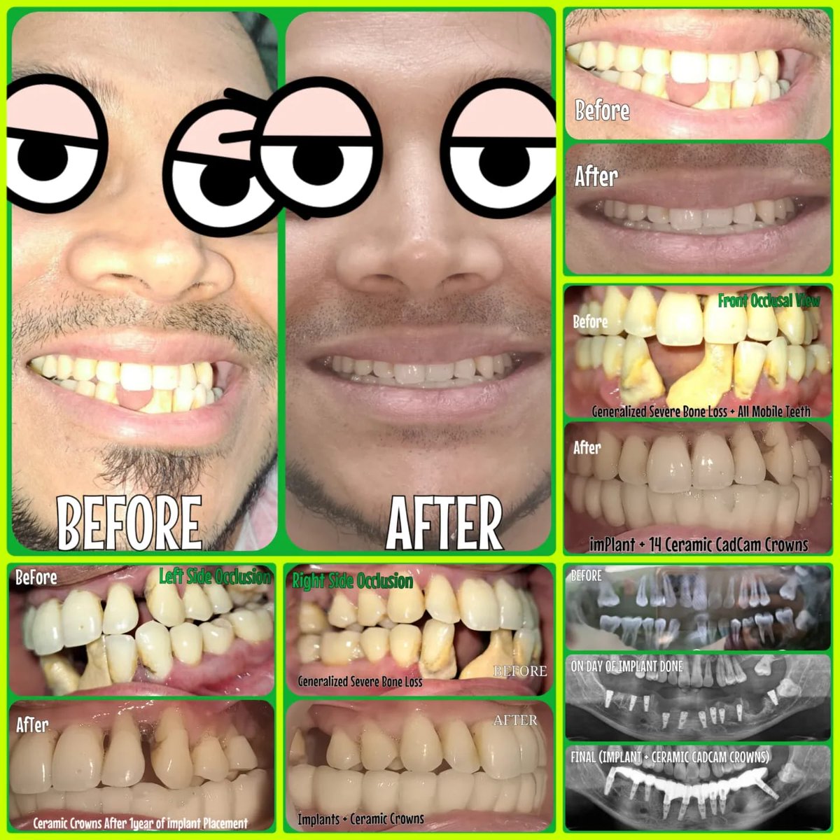 mother_dental's tweet image. ✅ No bone grafts used 
✅ No Bone Augmentation 
✅ Immediate implants 
✅ Immediate loading
✅ PainLess Procedure
✅ Buccal cortical engagement in lower posterior region 

🎖️ Dr.GIRISH H KHANDELWAL

 #implantcentreinkandivali #immediateloading #flaplesspterygoids #nervebypass