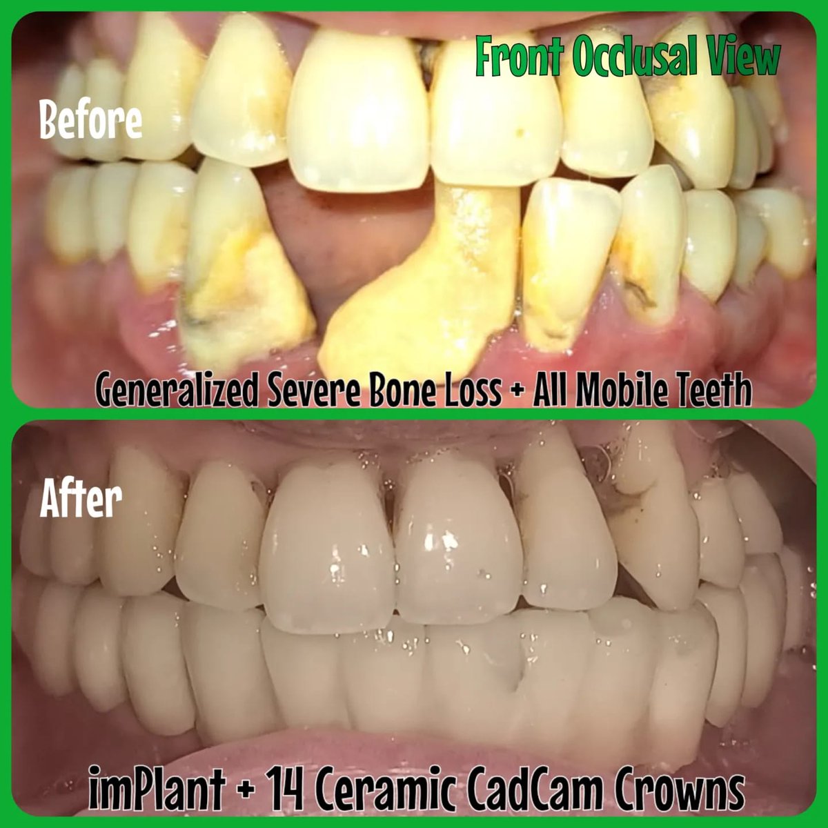 mother_dental's tweet image. ✅ No bone grafts used 
✅ No Bone Augmentation 
✅ Immediate implants 
✅ Immediate loading
✅ PainLess Procedure
✅ Buccal cortical engagement in lower posterior region 

🎖️ Dr.GIRISH H KHANDELWAL

 #implantcentreinkandivali #immediateloading #flaplesspterygoids #nervebypass