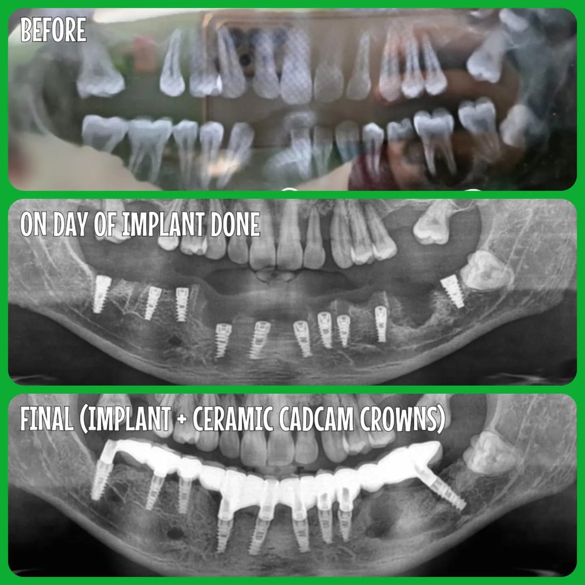mother_dental's tweet image. ✅ No bone grafts used 
✅ No Bone Augmentation 
✅ Immediate implants 
✅ Immediate loading
✅ PainLess Procedure
✅ Buccal cortical engagement in lower posterior region 

🎖️ Dr.GIRISH H KHANDELWAL

 #implantcentreinkandivali #immediateloading #flaplesspterygoids #nervebypass