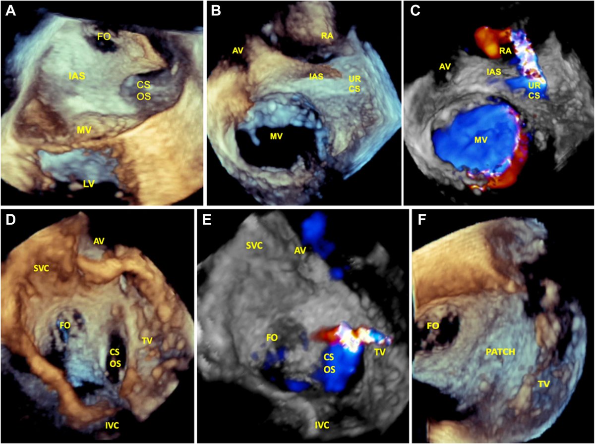 We present a series of 3 adult patients who presented to the adult echocardiography lab with previously undiagnosed unroofed CS to illustrate the typical presentation and imaging findings of this uncommon form of CHD. bit.ly/43bDcmk

#CASESpecialIssue #10DaysofCASE #ACHD