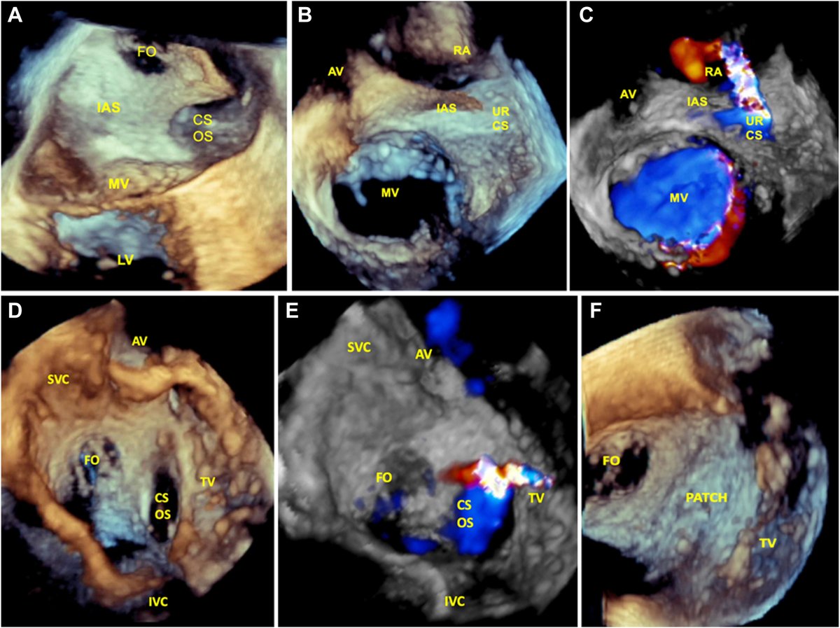 We present a series of 3 adult patients who presented to the adult echocardiography lab with previously undiagnosed unroofed CS to illustrate the typical presentation and imaging findings of this uncommon form of CHD. bit.ly/43bDcmk #CASESpecialIssue #10DaysofCASE #ACHD