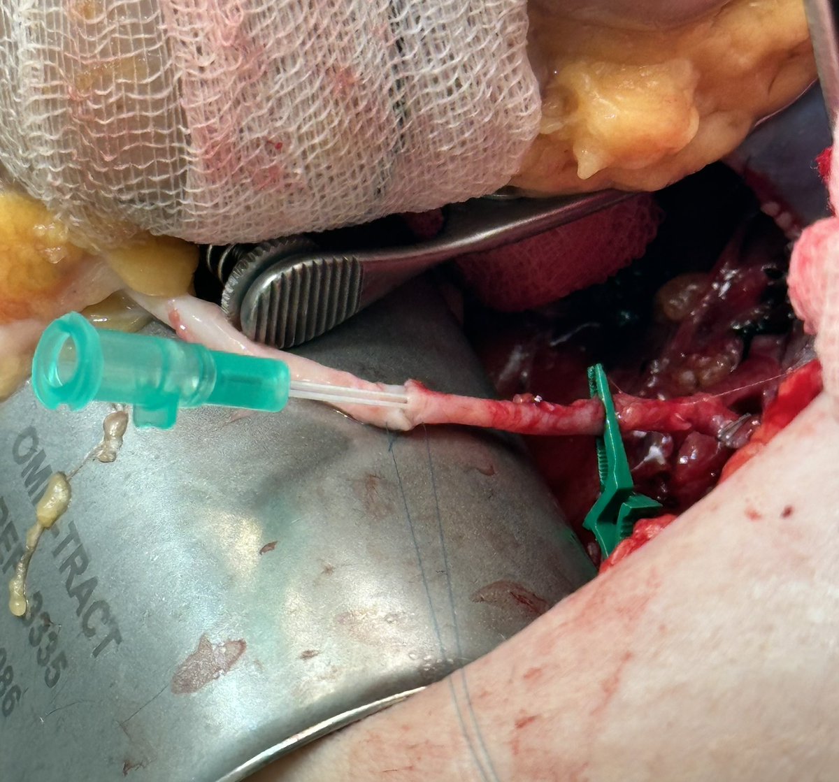 Leaving robotic surgery for a while: what #microsurgery contributes to kidney #transplantation. Reconstruction of polar arteries on bench and in field anastomosis to epigastric artery. All permeable. @TrasplanteAEU @EKITAmemories