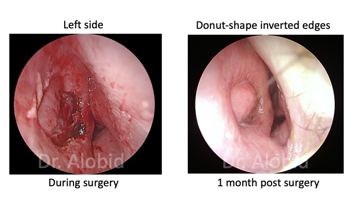 Me encanta el Donut / I love the Donut.
📷 Bonito resultado de cierre de #perforacionseptal con “Racket-on-Donut” del lado derecho. 1 mese después de la cirugía.
📷 Nice result after #septalperforation repair using right “Racket-on-Donut”. 1 months after surgery.