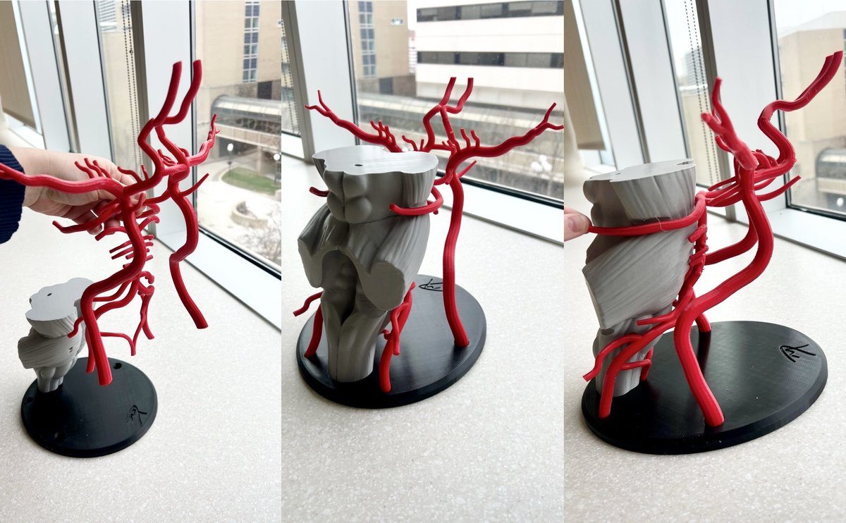 Christina Lineback (@linebackcm) on Twitter photo Commissioned <a href="/UMICHNeuroRes/">UM Neurology Residency Program</a>โs very own Dr. <a href="/DanielMannionMD/">Daniel Mannion</a> to make this amazing brainstem // circle of willis model for me! how cool is this!?! ๐ง ๐๐ป ๐ฉธ Excited to use it while reviewing vessel imaging for patients, trainees and students! #NeuroTwitter #stroketwitter Commissioned <a href="/UMICHNeuroRes/">UM Neurology Residency Program</a>โs very own Dr. <a href="/DanielMannionMD/">Daniel Mannion</a> to make this amazing brainstem // circle of willis model for me! how cool is this!?! ๐ง ๐๐ป ๐ฉธ Excited to use it while reviewing vessel imaging for patients, trainees and students! #NeuroTwitter #stroketwitter