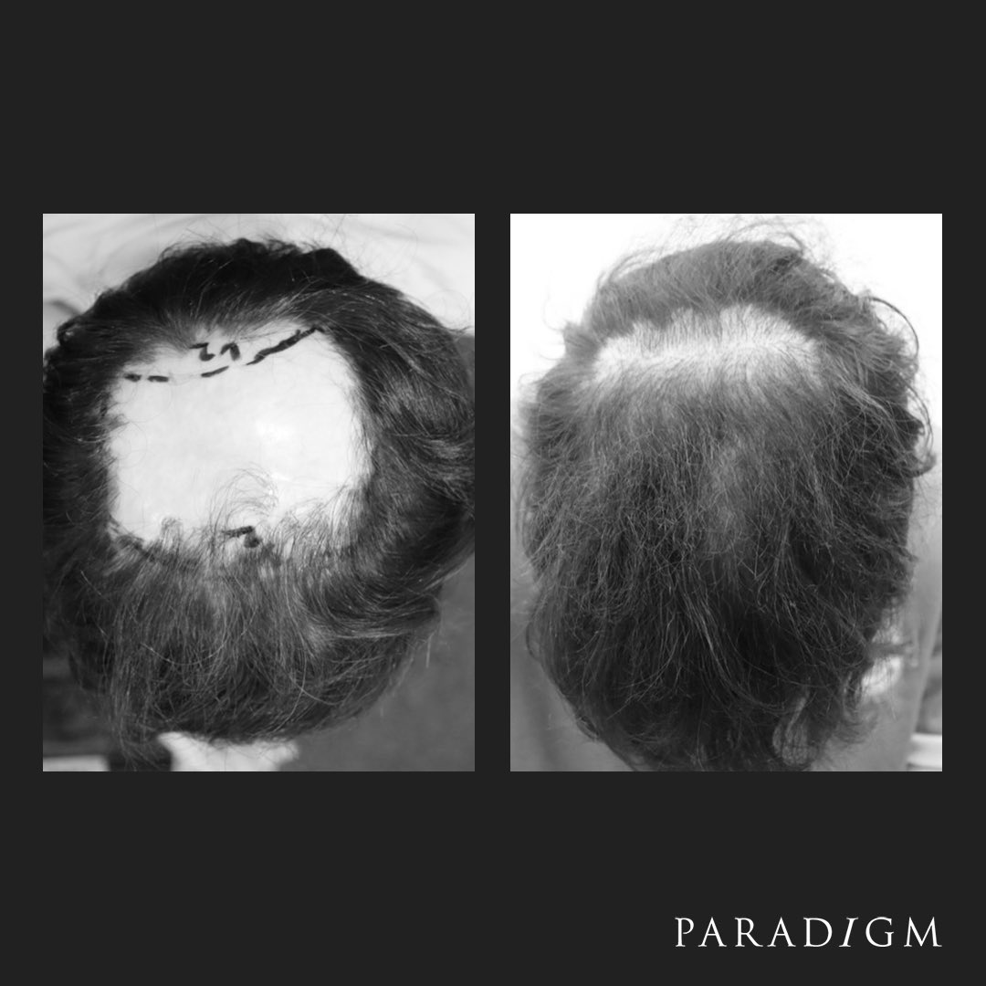 Paradigm’s Consultant Plastic Surgeon, Brendan Fogarty is an expert in scarring. This large skin graft was successfully transplanted using our Growth Optimisation Follicular Unit Extraction (GOFUE) method. #scar #scars #fuehairtransplant #hairgrowth