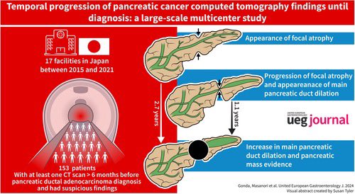 🔍 PDAC Study Highlights: - 47.8% showed early PDAC signs on CTs. - Focal atrophy & MPD dilatation visible 2.7 & 1.1 yrs pre-diagnosis. - Atrophy frequent in pancreatic body/tail. - No correlation >> PDAC stage & early CT signs. doi.org/10.1002/ueg2.1…