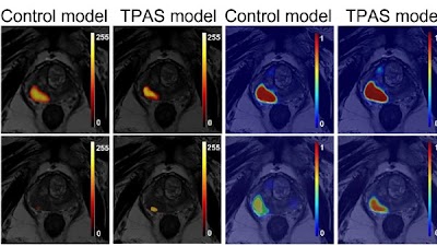 Targeted adversarial training with proprietary adversarial sample (#TPAS) model improved MRI prostate cancer diagnosis doi.org/10.1148/ryai.2… @BiocLnkgnEcwEfT #cancer #AI #ML