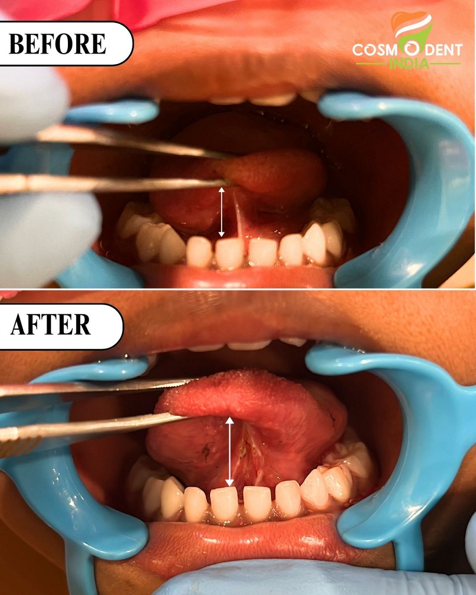 Unlocking the power of speech and taste! 🗣️✨ Say goodbye to tongue ties with Cosmodent India's expert tongue tie release procedure. Experience improved speech clarity and enhanced eating habits. Let your tongue move freely and feel the difference today! #TongueTie